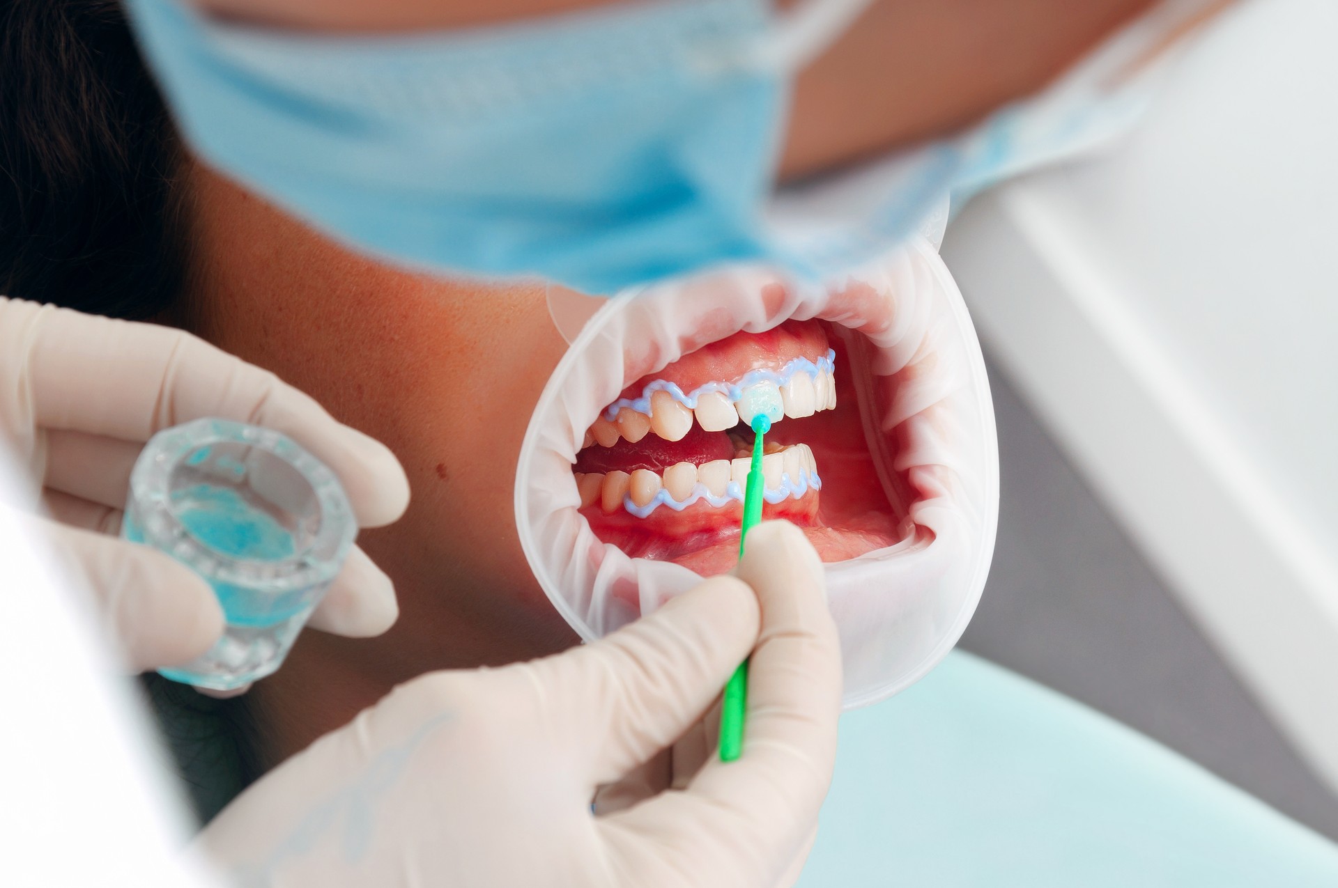 Dentist and patient applying product on a patient. Tooth whitening